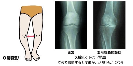 膝が痛いときは①